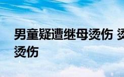 男童疑遭继母烫伤 烫伤部位被诊断为深二度烫伤