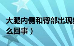 大腿内侧和臀部出现红斑（大腿内侧有红斑怎么回事）