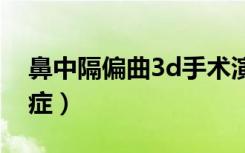 鼻中隔偏曲3d手术演示（鼻中隔矫正术后遗症）