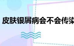 皮肤银屑病会不会传染（银屑病会不会传染）