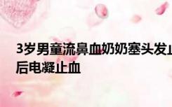 3岁男童流鼻血奶奶塞头发止血致休克，医生手术取出异物后电凝止血